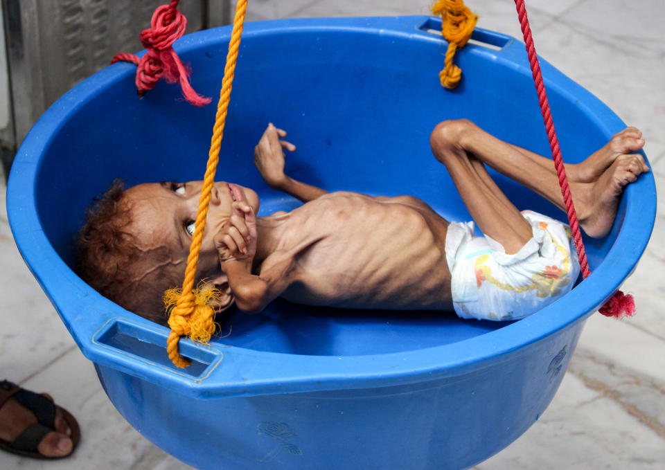 <p>A Yemeni child suffering from malnutrition is weighed at a hospital in the northern district of Abs in the northwestern Hajjah province on September 19, 2018. The three-year conflict between Yemen’s Saudi-backed government and Huthi rebels linked to Iran has pushed the already impoverished country to the brink of famine, leaving many unable to afford food and water, with a total of 5.2 million children at risk of starvation according to the Britain-based NGO Save the Children. (Photo by ESSA AHMED/AFP/Getty Images) </p>