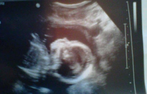 An ultrasound photo of my unborn son, Azlend, taken at 19 weeks on the day his congenital diaphragmatic hernia was discovered. (Photo: Courtesy of Amber Harrington)