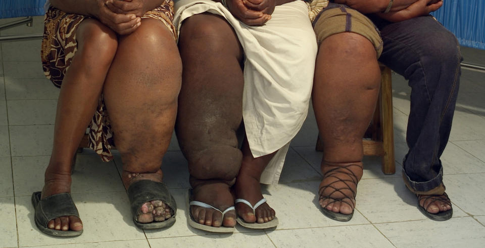 Three female patients in Haiti display their swollen legs, a symptom of&nbsp;elephantiasis. (Photo: Maggie Steber/The Washington Post via Getty Images)