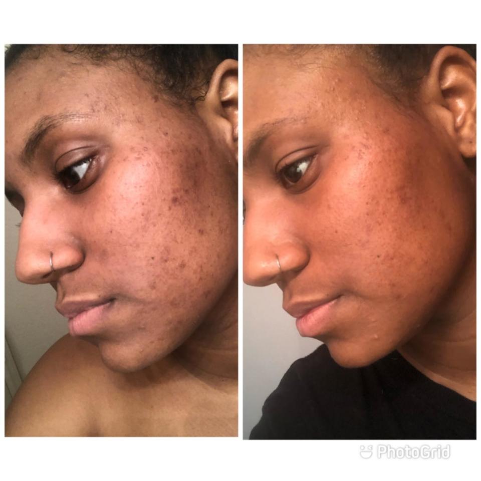 A reviewer's skin before and after use, with reduced texture, acne, and redness after