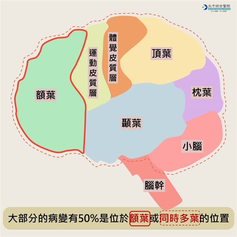 大千綜合醫院粉專小編發文【突發性語言障礙？小心罕見中樞神經性淋巴瘤】（圖／翻攝自大千綜合醫院粉專）