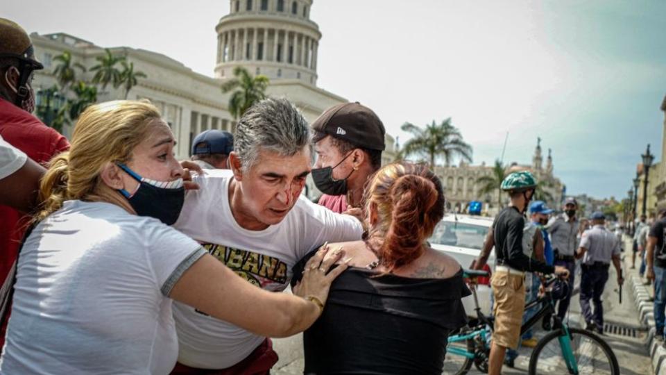 Hombre tras sufrir una lesión en el rostro durante las protestas en Cuba.