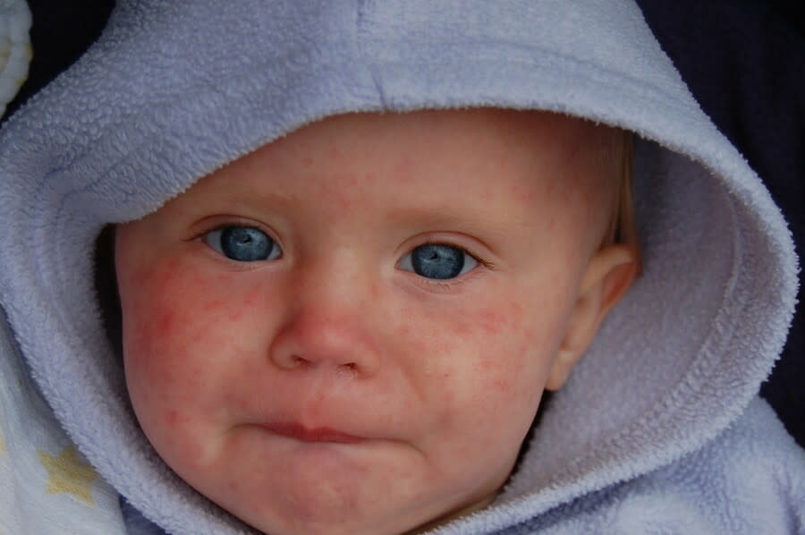 世界衛生組織指出，一年來全球麻疹病例幾乎增長一倍，2024年迄今麻疹病例已超過94000例。（Photo by Liz on Flickr under C.C. License）