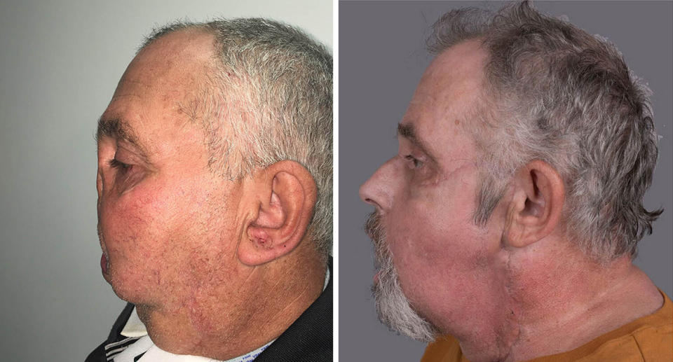 Canadian man Maurice Desjardins, pictured before and after, received a new face from Transplant Quebec.