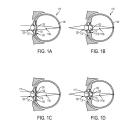 Der kleine injizierte Chip beinhaltet angeblich Sensoren, Speicherplatz und eine Linse, die letztendlich die herkömmliche Brille obsolet machen sollen. Strom soll wiederum aus der Luft in Form von umgewandelten Funkwellen aggregiert werden.