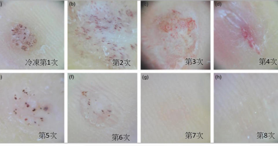 病毒疣接受冷凍治療後的變化／圖片來源：林昱廷醫師提供