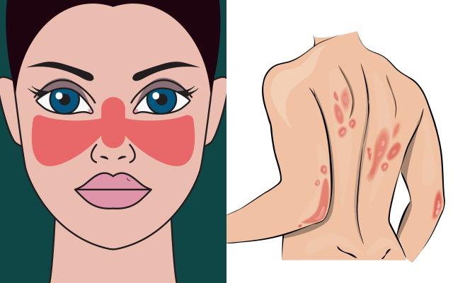 紅斑性狼瘡因患者臉部出現的典型蝴蝶狀紅斑，有如被狼咬傷，因而得名。部分患者身上也會出現紅斑、血點。（示意圖／Getty Images）