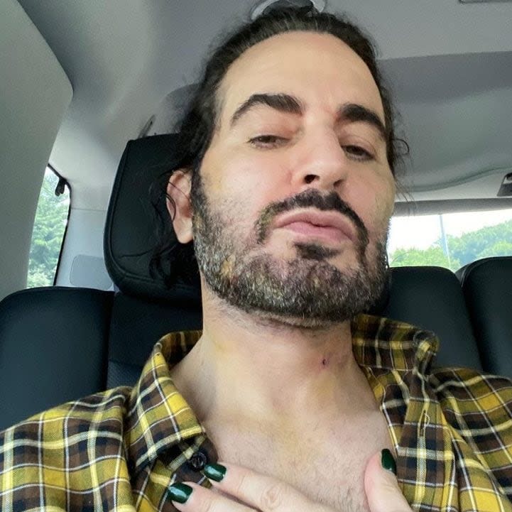 Marc Jacobs after his deep plane facelift