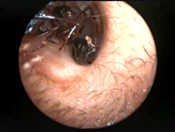 Girl's ear infested with giant ants' nest (video)