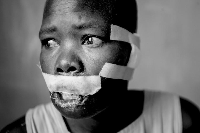 Kitgum, Gulu,Pader-Northern Ugando-2/19/2004--Portrait of Lokeria Aciro (CQ), 40, at Saint Joseph's Hospital near Kitgum, northern Uganda. She was one of two woman at the hospital healing after having their lips and ears cut off by the LRA. The women had been collecting firewood with a larger group of women. They were the only women cut, and the others were abducted by the rebels. According to the women one young boy about 11 years old cut their lips. They had been staying in an IDP camp, but left to collect firewood in the morning. They said they were about 1.5 kilometers from the camp. When asked if she had hope for peace, she said she "didn't know", only that she would "return to living in the IPD camp, in a life of poverty."