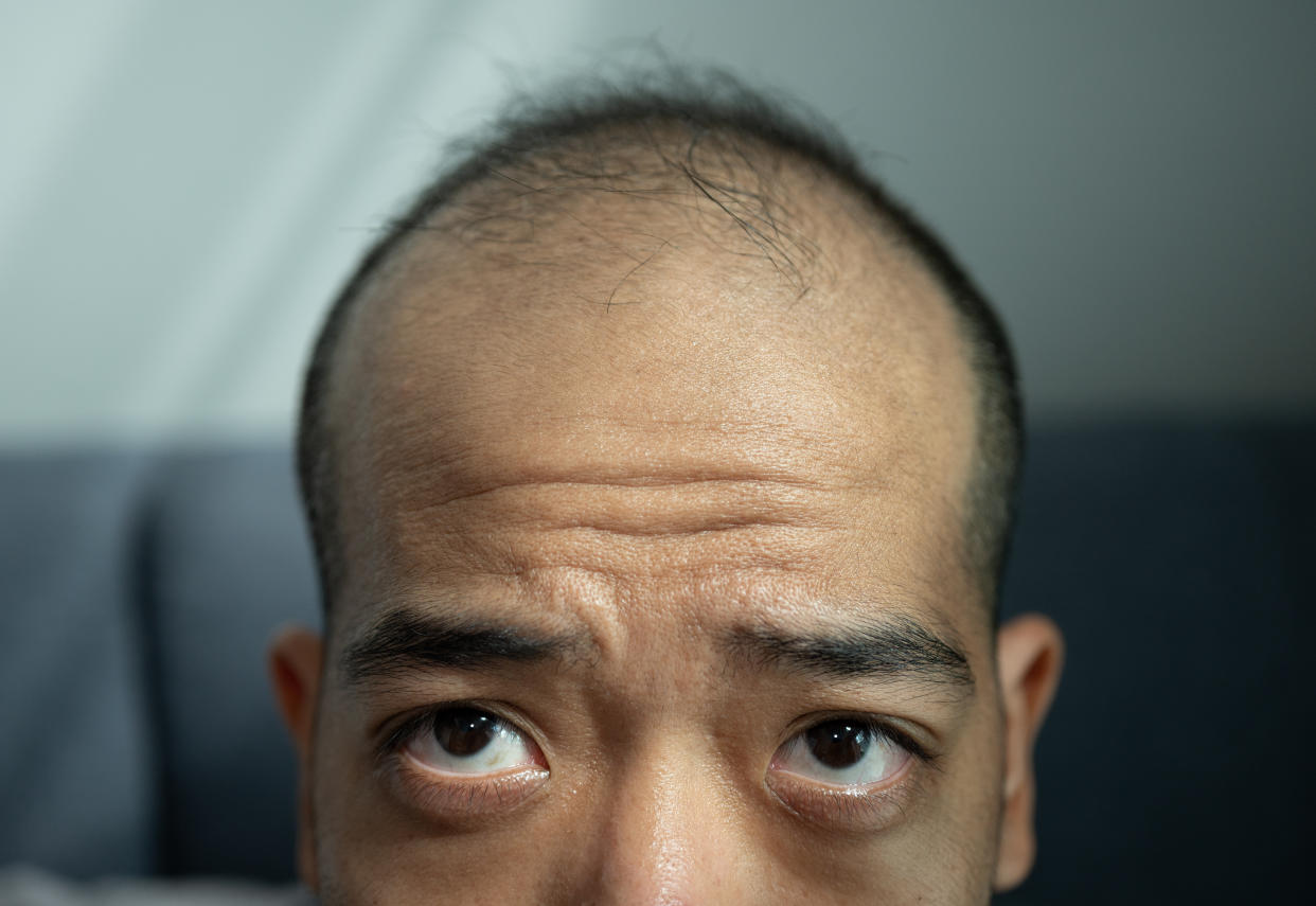 Conceptual of hair problem on men's head.