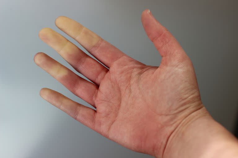 El síndrome de Raynaud afecta hasta al 22% de la población mundial