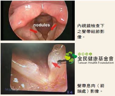 聲帶結節是指聲帶表皮增厚、皮下組織水腫，通常與聲帶過度使用有關。