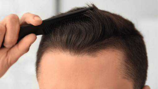 Best Hair Loss Treatments in Malaysia That You Need To Try Today