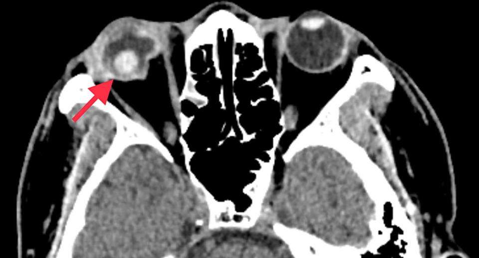 A CT scan of a man's head reveals an injury to his right eye.