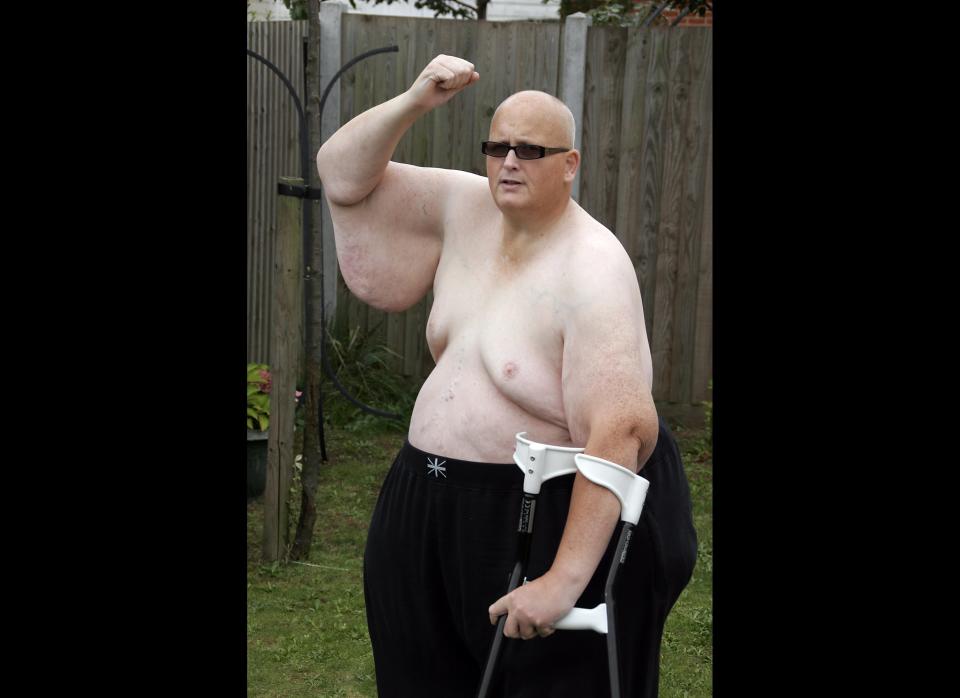 Paul Mason, 50, who weighed 60 stone two years ago, underwent a gastric bypass after he was told he otherwise faced certain death. But he has been left with rolls of unsightly excess skin after the extreme weight loss and now needs an operation to remove the flaps hanging from his stomach, arms and legs. However, NHS bosses have refused to perform cosmetic surgery, insisting that he needs to maintain a stable weight before it can be considered.  