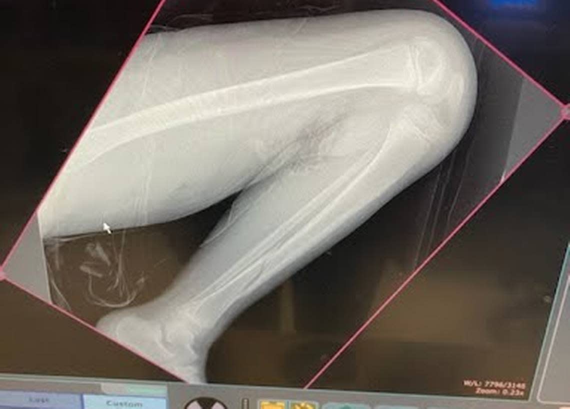 Micah Reed, 8, broke his leg (seen near his ankle) at a North Texas trampoline park.