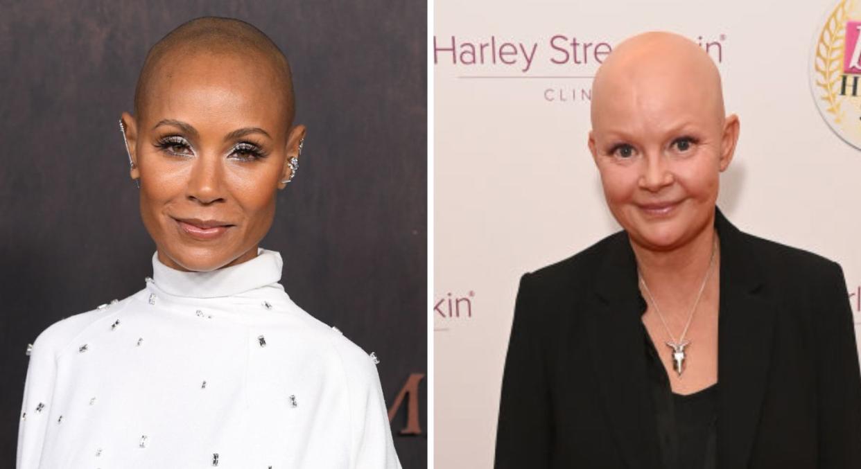 Jada Pinkett-Smith and Gail Porter have also documented their experiences of alopecia. (Getty Images)