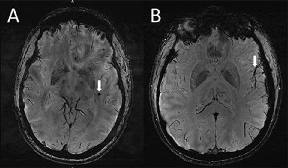 (A) Cerebral microbleeds (CMB) visualized as round, dark lesions (arrow) on SWI sequence in the left temporal lobe in a migraine case with aura. (B) Asymmetry in the appearance of the cortical vessels is more prominent on the left side (arrow) ipsilateral to the CMB.