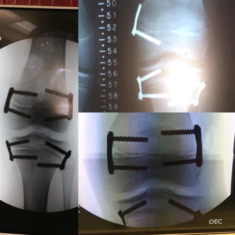 X-rays of Rin Drudge's knee post-surgery with plates and screws.