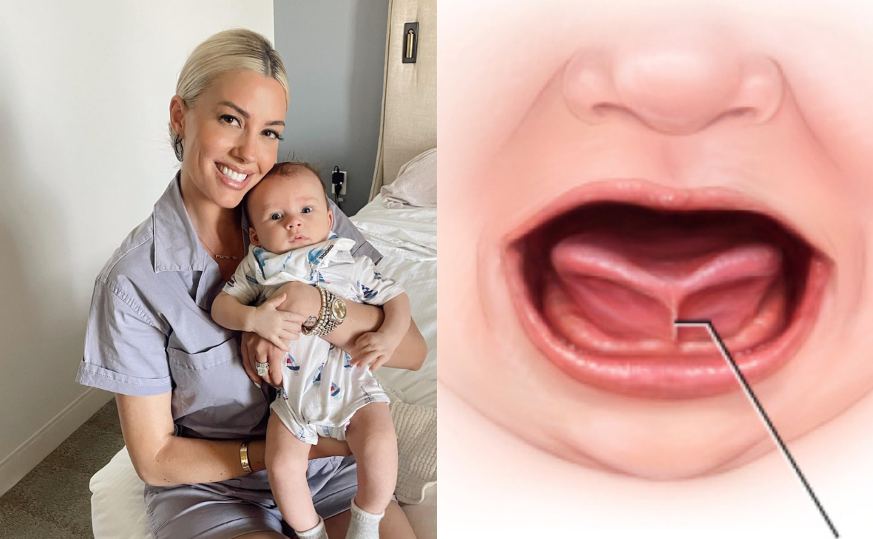 Heather Rae El Moussa opened up about her son's tongue-tie surgery on Instagram.  (Instagram/@theheatherraeelmoussa; mayoclinichealthsystem.org)