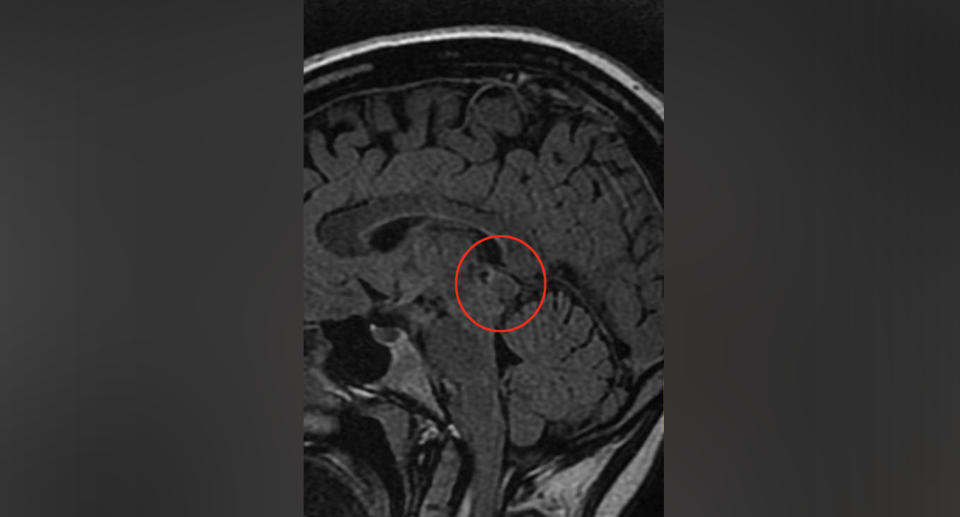 An MRI scan (pictured) confirmed that Ms Holden had a pineal cystic brain tumour which is now 10 by 11 millimetres large. Source: Supplied