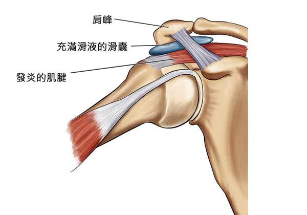 夾擠症候群為一種臨床症狀，包含多種不同診斷，如旋轉肌腱炎。(圖片提供／台北慈濟醫院)