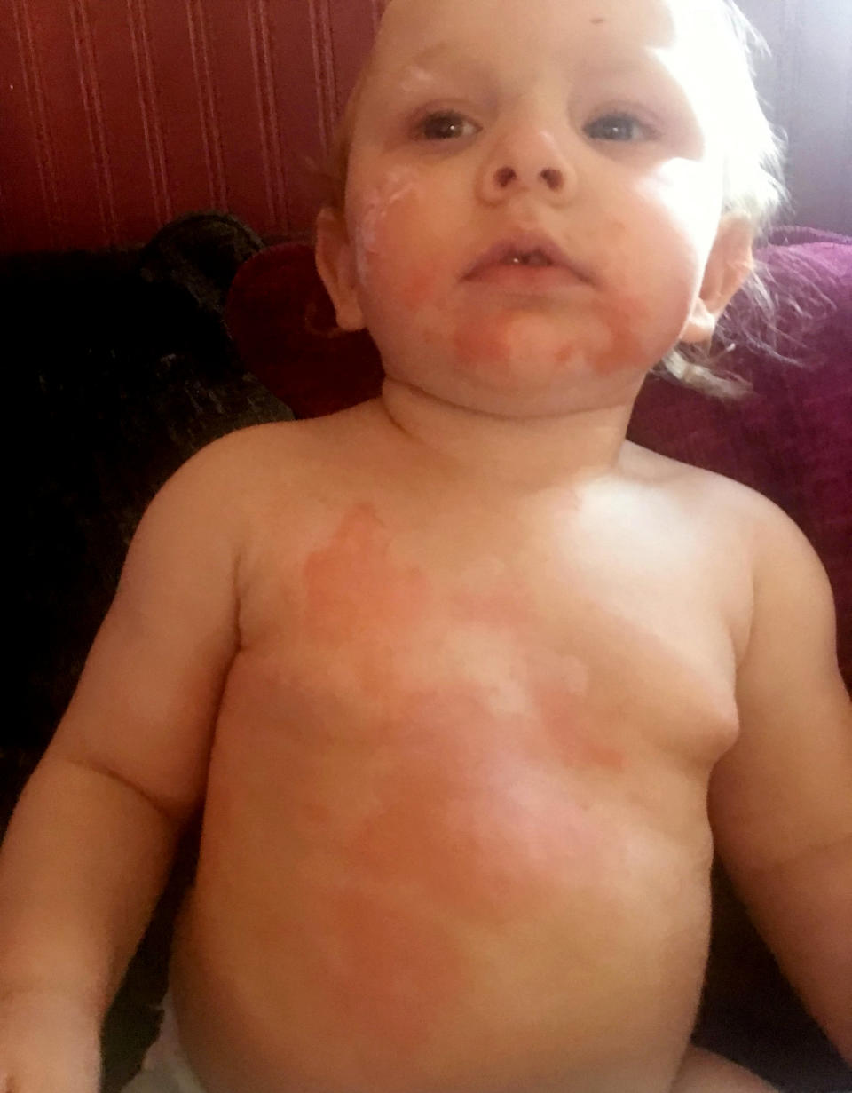 Alice was left with a red rash over her body [Photo: SWNS]