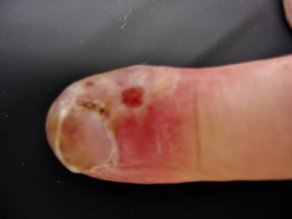 An unexpected virus gave a 23-year-old man this finger infection.