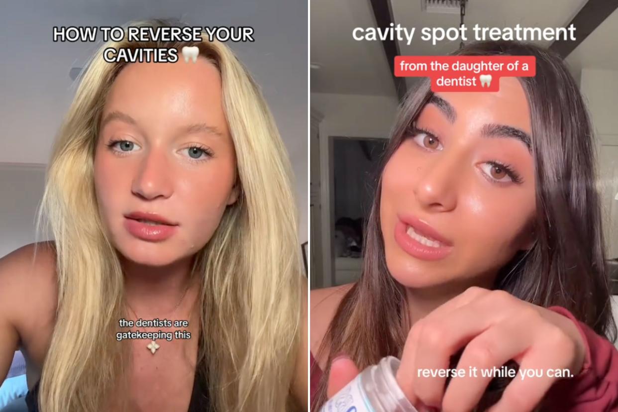 Side-by-side screengrabs of TikTok videos about cavity treatment.