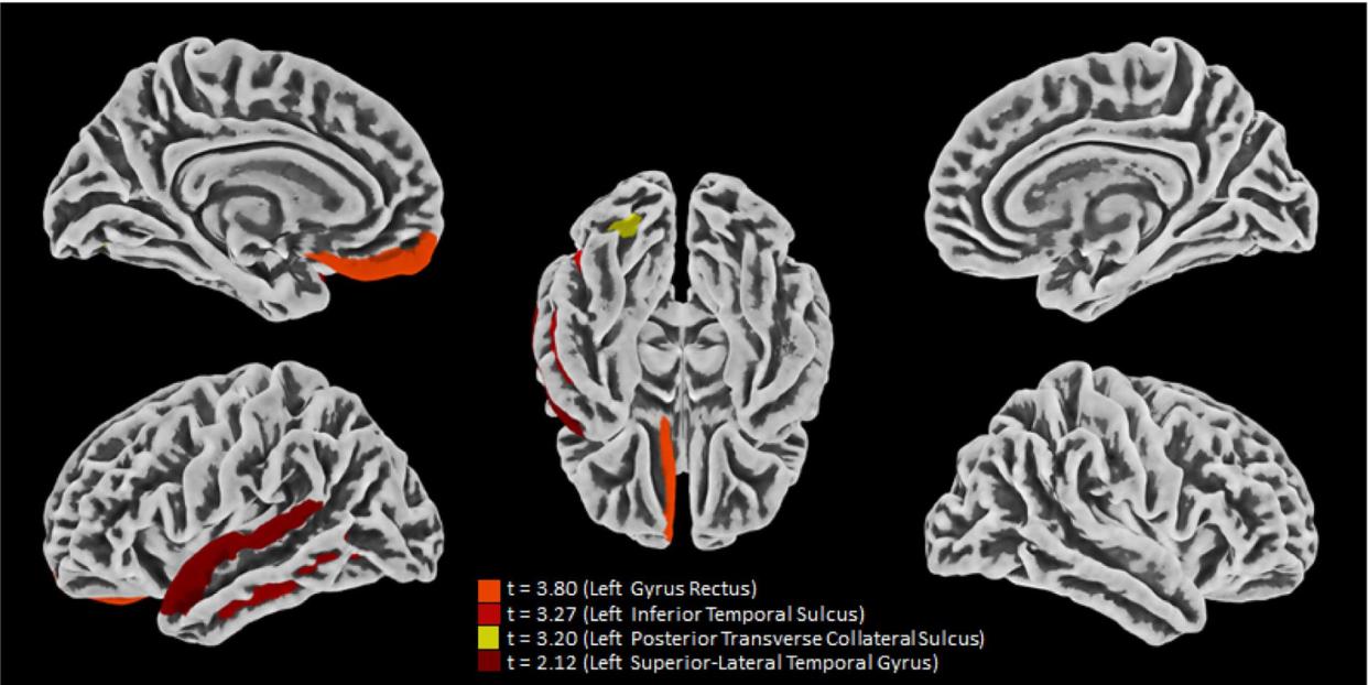 Atrofia del espesor cortical tras una infección leve por COVID-19 | Crunfli et al. PNAS