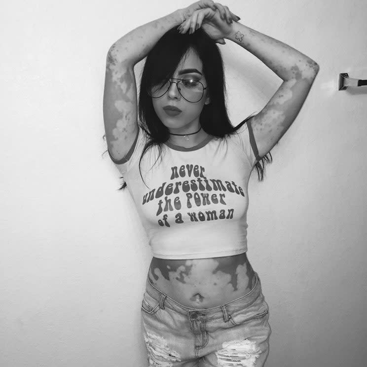 Black-and-white photo of a woman with vitiligo wearing a T-shirt that reads 