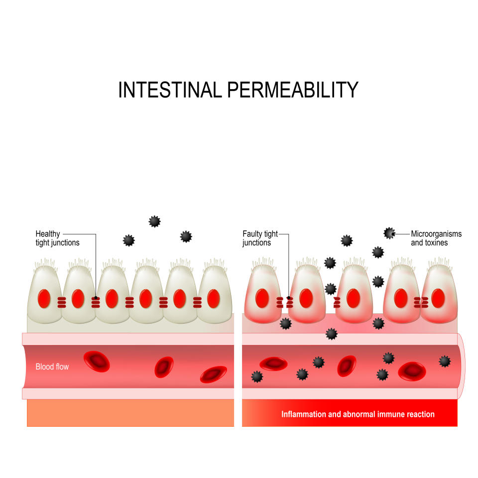 leaky gut. Intestinal permeability. cells on gut lining held tightly together. in intestine with celiac disease and gluten sensitivity these tight junctions are open. substances, microbes and toxines uncontrolled passage into the bloodstream. development of immune and inflammatory reactions. autoimmune disorder.