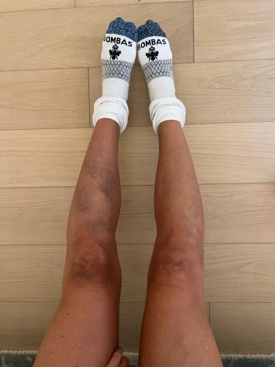 Legs covered in vericose veins