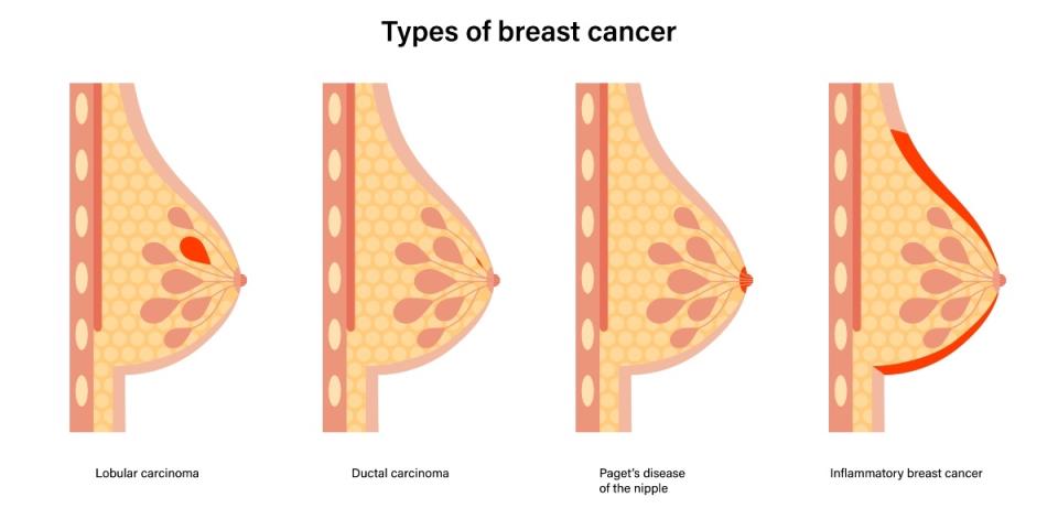 An illustration of various types of breast cancer