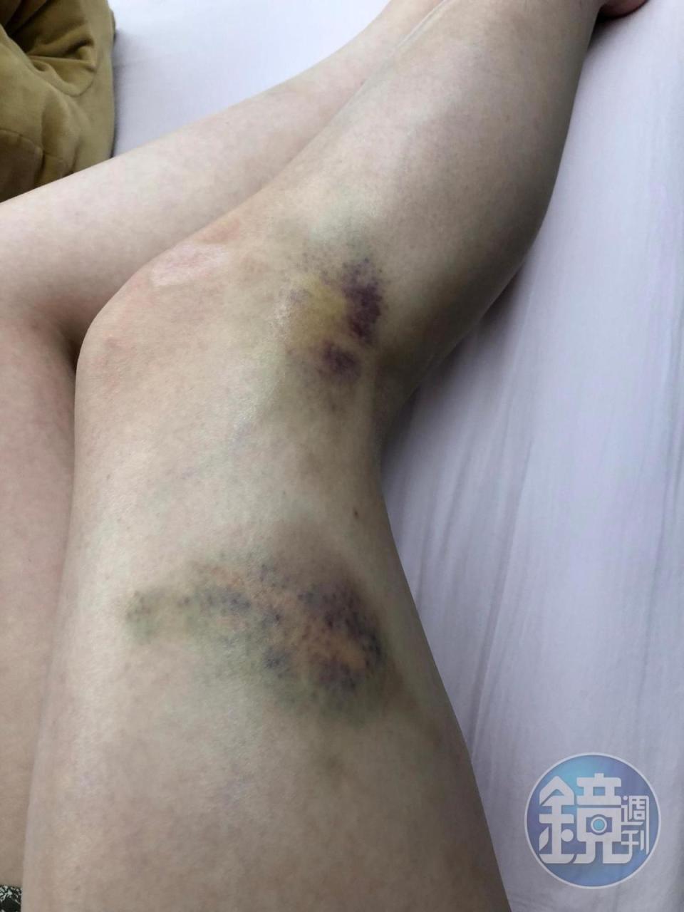 受害女腿部也有大面積傷勢。（讀者提供）