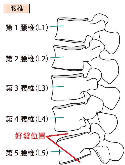 椎間盤突出的原因