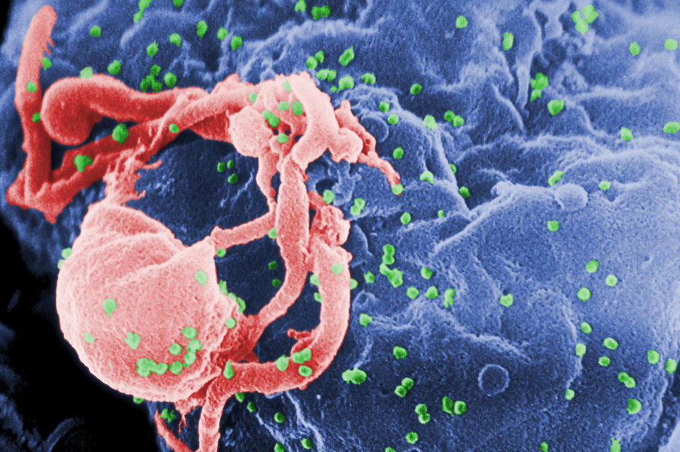 A scanning electron micrograph of multiple round bumps of the HIV-1 virus on a cell surface.&nbsp; (Photo: Cynthia Goldsmith/Centers for Disease Control and Prevention via AP)