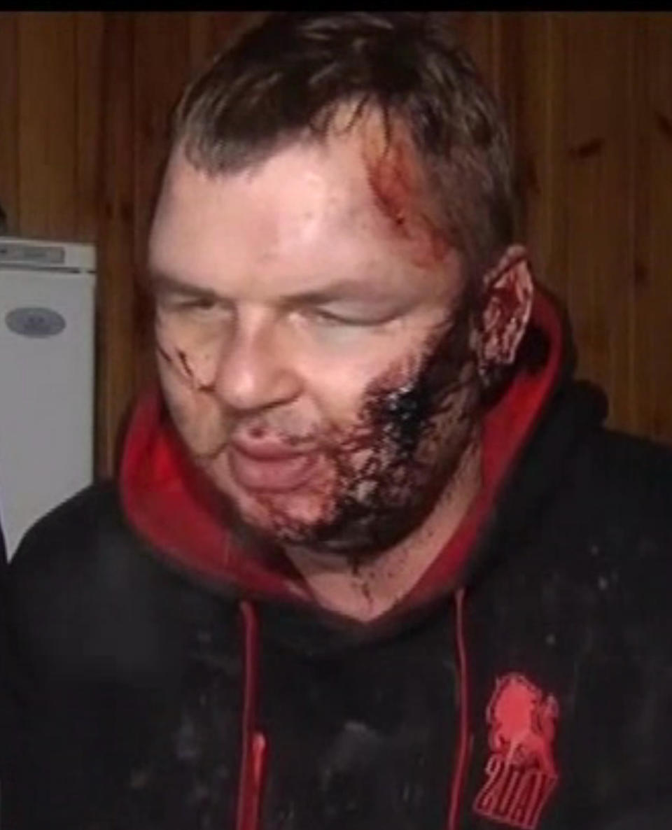 In this frame grab provided by 5 Channel, bloody Dmytro Bulatov speaks to press after he was found near Kiev, Ukraine, Jan. 31, 2014. Bulatov, an opposition protester who disappeared more than a week ago says he was kidnapped and tortured by unknown assailants, in a chilling development that is likely to further stoke anger against the embattled government of President Viktor Yanukovych. Dmytro Bulatov, is the latest in a string of disappearances and mysterious attacks on prominent opposition leaders, which left one activist dead and several badly beaten. (AP Photo/5 Channel)