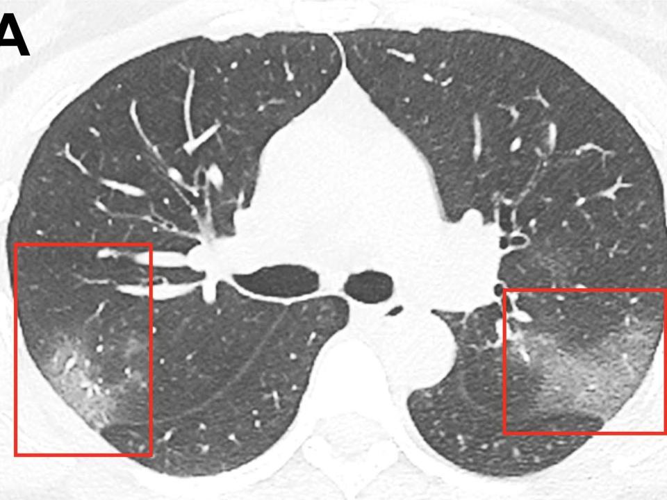 Coronavirus patient chest x ray