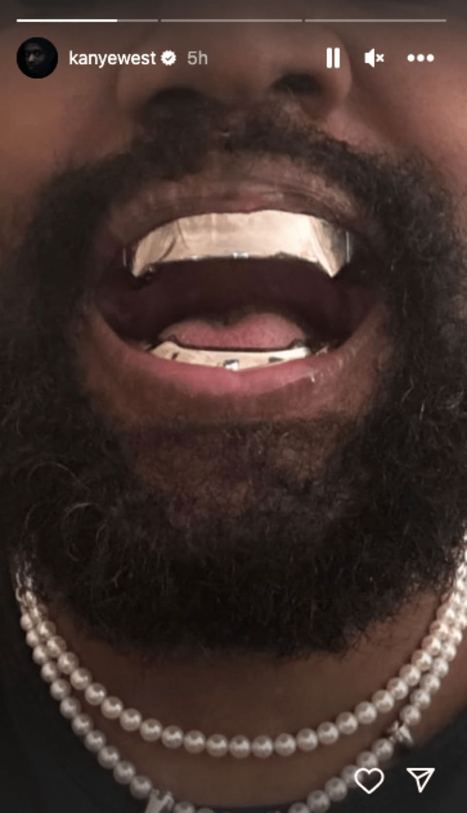 Dientes de metal dentro de la boca de Kanye West (Kanye West/Instagram)