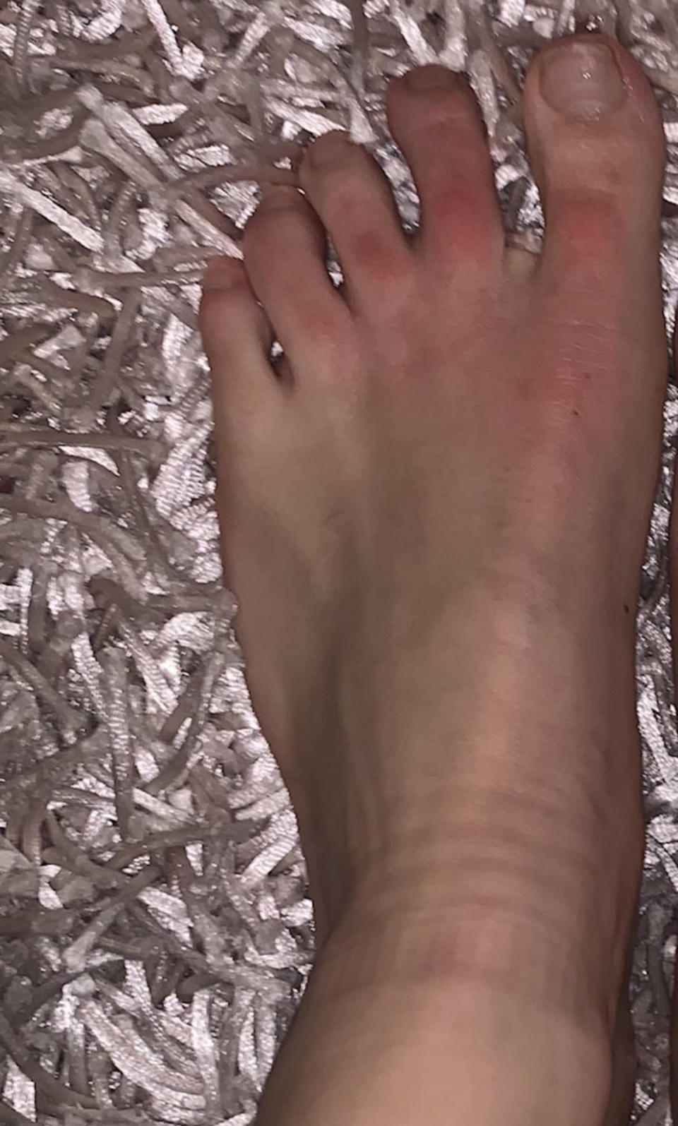 Rachel Sommer, who lives in Long Island, New York, shared a picture of her foot condition on Twitter. She did not get tested for coronavirus, but her symptoms included a slightly raised temperature, decreased appetite, fatigue, difficulty breathing and a sore throat. (Rachel Sommer)
