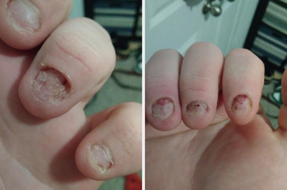 Close-up images of hands with severely bitten fingernails showing damaged cuticles and nail beds