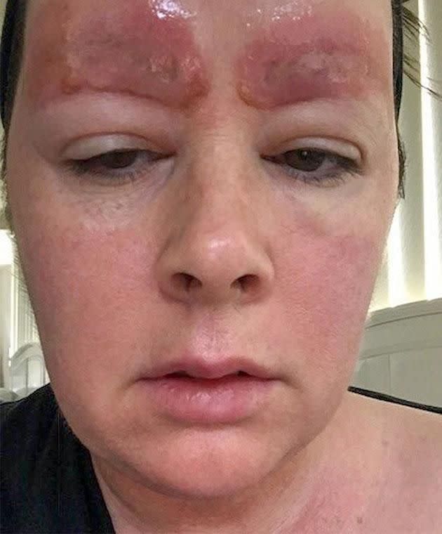 Amanda Coats a confié que sa peau se détachait de ses sourcils à son réveil. (Photo : Caters News)