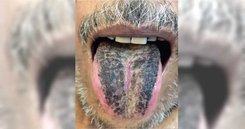 印度50多歲男子舌頭長滿厚厚一層黑色絨毛。（圖／翻攝自《JAMA皮膚病學雜誌》）