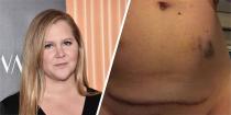 <p><a href="https://www.cosmopolitan.com/uk/body/health/a30467281/amy-schumer-ivf/" rel="nofollow noopener" target="_blank" data-ylk="slk:Amy Schumer;elm:context_link;itc:0;sec:content-canvas" class="link ">Amy Schumer</a> is about as open as they get, especially where body image is concerned. After giving birth via c-section to her first child, Gene, last May, the comedian hasn't shied away from sharing the realities of a post-birth body - and that includes her scar. In one Instagram picture, posted just a couple of months after giving birth, Amy can be seen lifting her top up to reveal her caesarean-section scar. "I'm really sorry if I offended anyone with my hospital underwear," she captioned the photo. "Except I'm just kidding."</p><p>This is one woman who just does not care what anyone thinks of her body, and it's liberating.</p>