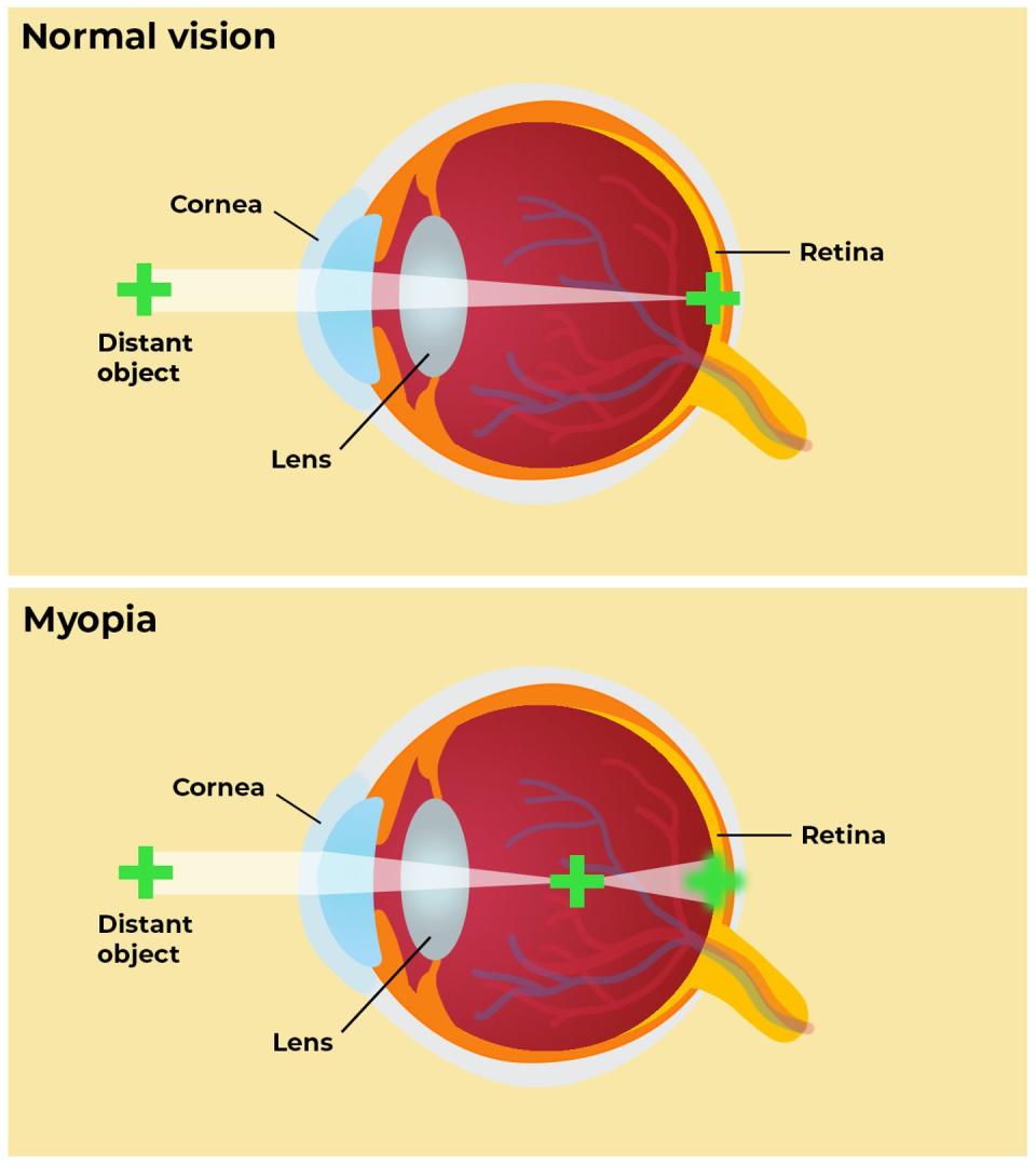 <span class="caption">In people with myopia, light focuses in front of the retina rather than on it, so distant objects appear blurry.</span> <span class="attribution"><span class="source">Anurag Papolu/The Conversation</span>, <a class="link " href="http://creativecommons.org/licenses/by-sa/4.0/" rel="nofollow noopener" target="_blank" data-ylk="slk:CC BY-SA;elm:context_link;itc:0;sec:content-canvas">CC BY-SA</a></span>