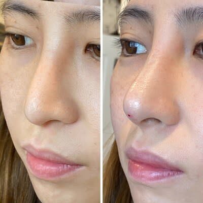 Before and After photo courtesy of PDO Max Trainer Hula Castellon, FNP, MSN, founder of Uplifted Aesthetics in Redondo Beach, CA.  *Not related to studies.