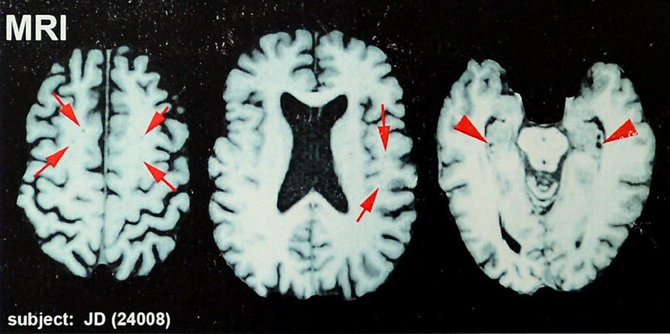 A 3rd of former NFL avid gamers surveyed assume they’ve CTE, find out about suggests