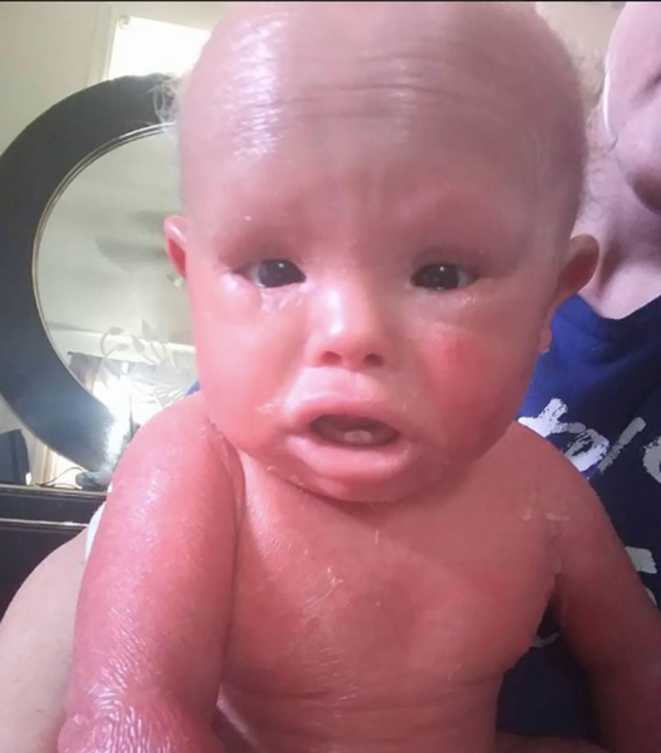 Jamison needs to be bathed in bleach to remove harmful bacteria. Source: Facebook/ Jamison, Little Butterfly-Harlequin Ichthyosis